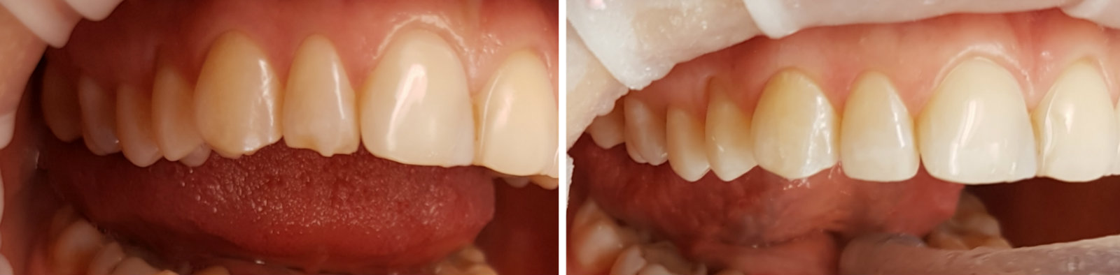 Восстановление скола зуба