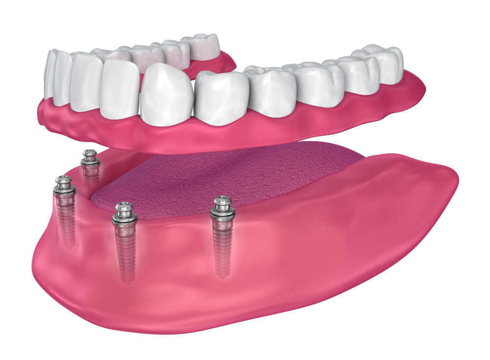 имплантация зубов All-on-4