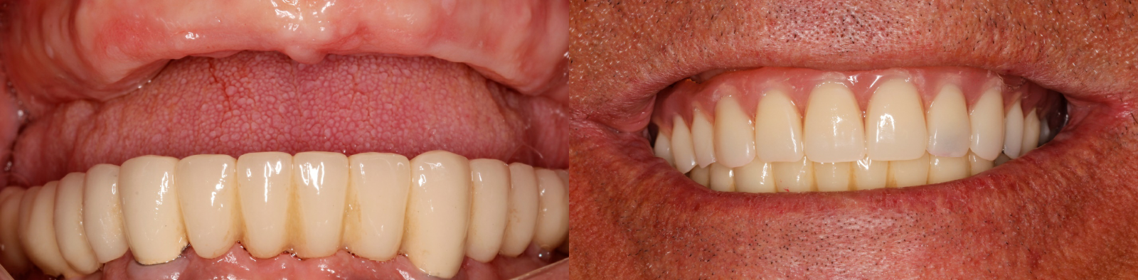 Восстановление зубов в верхней челюсти по методике «Все-на-6»
