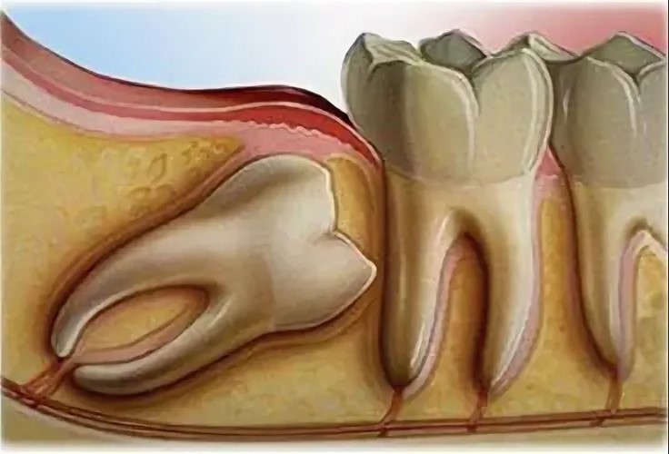 Застревает еда между зубами – поможет замена коронок для создания плотного контакта