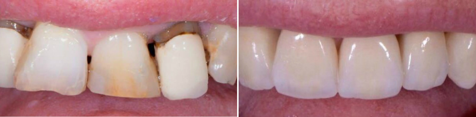 Восстановление зубного ряда коронками и винирами